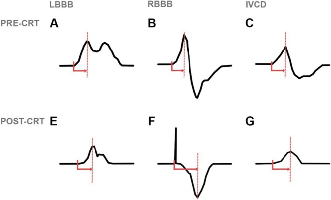 Examples of LVAT measurements in the different QRS morphologies. LVAT is measured as the time of QRS onset to maximum deflection in lead V6.