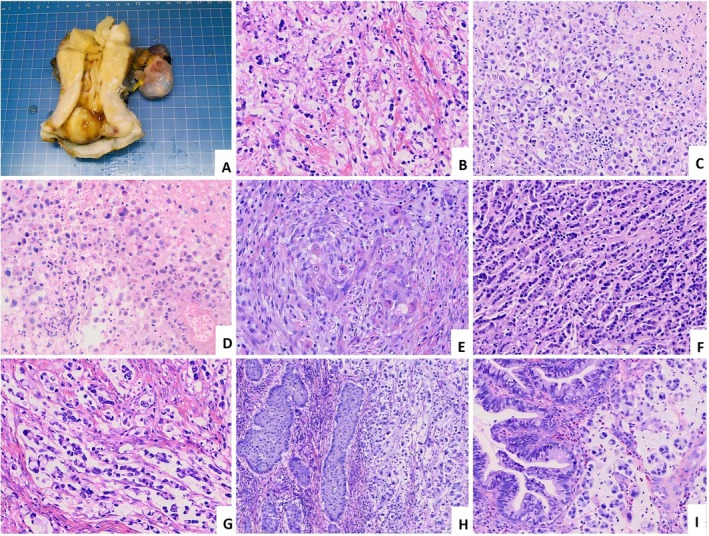 HPV‐associated cervical poorly cohesive carcinomas (CPCC), NOS subtype (A–G), and mixed subtype (H and I). (A) A raised mass is visible in the cervix. (B) The neoplastic cells demonstrate low cohesiveness, predominantly arranged as single cells. (C) Lymphoma‐like tumor cells, with visible tumor thrombus. (D) Histiocyte‐like tumor cells. (E) Scattered single eosinophilic tumor cells in desmoplastic stroma. (F) Tumor cells in an ‘Indian filing’ pattern (referring to a single‐file linear arrangement). (G) Tumor cells mixed with features of signet‐ring cell carcinoma. (H) Invasive stratified mucin‐producing carcinoma (ISMC) component (left); (I) Conventional cervical adenocarcinoma component (left).