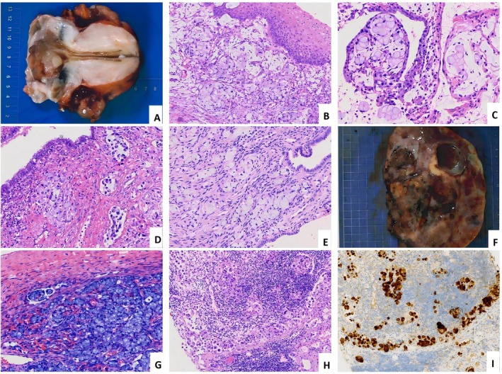 HPV‐associated cervical poorly cohesive carcinomas (CPCC), signet‐ring cell carcinoma subtype. (A) Invasive cervical mass with grayish‐white cut surfaces exhibiting a soft, delicate texture. (B–D) Tumor cells display signet‐ring cell morphology, infiltrating cervical stroma with evident lymphovascular invasion. (E) Cancer cells invading the endometrial stroma. (F and G) Ovarian metastasis: The cut surface appears gray‐white with fish‐flesh texture, showing marked hemorrhage and cystic degeneration; tumor cells infiltrate the ovarian stroma. (H and I) Metastasis to cervical lymph nodes, confirmed by P16‐positive.