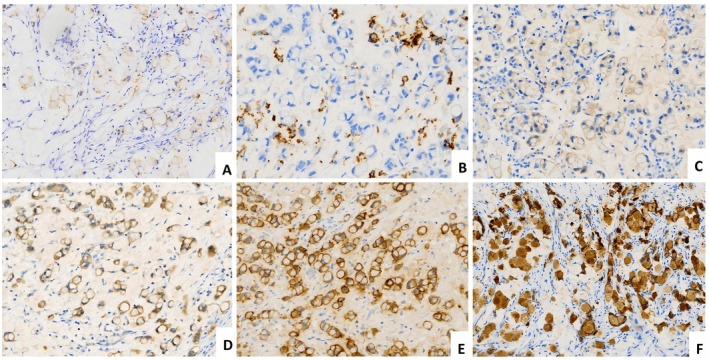 Immunohistochemical features of HPV‐associated cervical poorly cohesive carcinomas (CPCC). (A) Tumor cells show faint expression of E‐cadherin. (B) PD‐L1 shows partial positivity in immune cells. (C) HER2 2+. (D) Nectin‐4 2+. (E) TROP2 3+. (F) TF 3+.