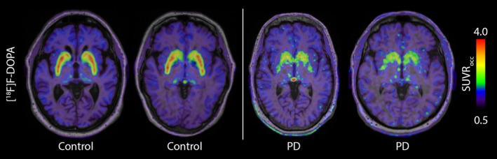 [18F]DOPA positron emission tomography (PET) in healthy controls and patients with Parkinson's disease (PD). Images of two healthy controls (left) and two participants with PD (right). Higher [18F]DOPA uptake is seen in the striatum of control participants, whereas uptake in PD patients is diminished reflecting the dopamine synaptic loss present in PD. Colour bar denotes standardised uptake value ratios (SUVRs) calculated using the occipital cortex (occ) as reference region where red equals higher [18F]DOPA uptake. Participants underwent [18F]DOPA PET as part of the Swedish BioFINDER studies (www.biofinder.se).