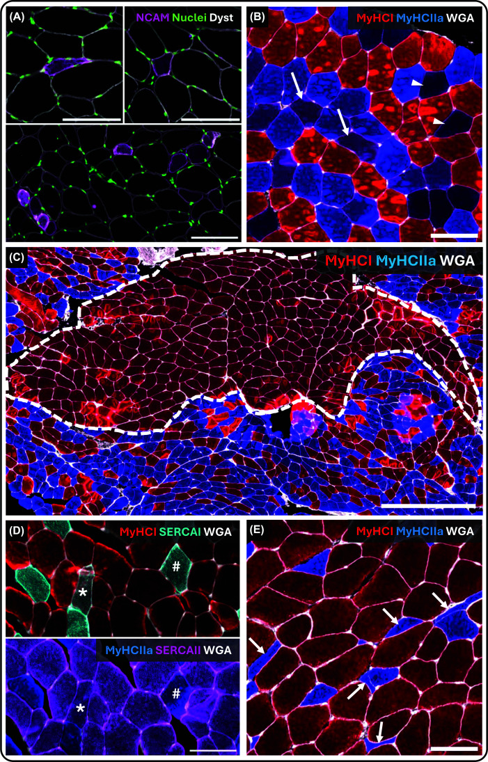 Histological indices of denervation in human skeletal muscle biopsies(A) NCAM-positive fibres, which are frequently atrophic and variably deformed, ranging from highly distorted morphologies (upper left) to more rounded profiles (upper right). Regions with increased local prevalence of NCAM-positive fibres are occasionally observed (bottom). NCAM (purple), nuclei (green), dystrophin (grey). Scale bar = 100 μm. (B) Hybrid fibres visualised by immunofluorescence staining for MyHC I (red), MyHC IIa (blue), and wheat germ agglutinin (WGA; grey). Purple fibres (arrows) indicate type I/IIa hybrids, whereas black or dark blue fibres (arrowheads) correspond to type IIa/IIx or IIx fibres. Scale bar = 100 μm. (C) Fibre-type grouping visualised using MyHC I (red), MyHC IIa (blue), and WGA (grey), illustrating a large fascicle composed almost exclusively of type I fibres adjacent to fascicles with mixed fibre-type composition. Grouped fibres are delineated by a white dotted line. Scale bar = 500 μm. (D) Serial sections illustrating fibre-type-specific expression of sarco/endoplasmic reticulum Ca2+-ATPase (SERCA) isoforms. Top: MyHC I (red), SERCA I (cyan), and WGA (grey). Bottom: MyHC IIa (blue), SERCA II (purple), and WGA (grey). Asterisks (*) indicate MyHC I-positive fibres co-expressing two SERCA isoforms, and hash symbols (#) indicate MyHC IIa-positive fibres co-expressing two SERCA isoforms. Scale bar = 100 μm. (E) Fibre deformity quantified using the shape factor index (SFI). Type II fibres exhibit marked atrophy and deformation, whereas type I fibres largely retain size and shape. Arrows indicate fibres with extreme levels of deformation (SFI >2.0). MyHC I (red), MyHC IIa (blue), and WGA (grey). Scale bar = 100 μm. Abbreviations: MyHC, myosin heavy chain; WGA, wheat germ agglutinin; SERCA, sarco/endoplasmic reticulum Ca2+-ATPase; NCAM, neural cell adhesion molecule; SFI, shape factor index.