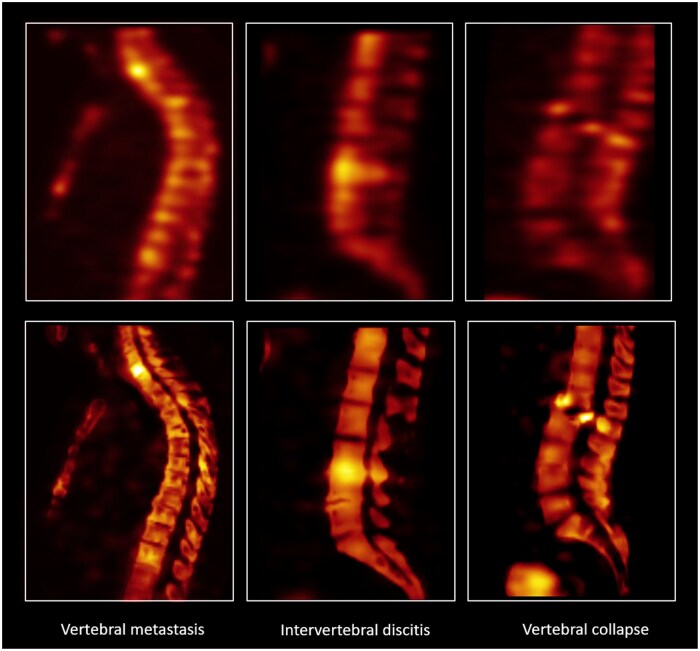 Figure 4. Example of OSCGM reconstruction with Siemens’ xSPECT bone algorithm compared to a standard bone scintigraphy reconstruction, demonstrating improved delineation of vertebral structure. Image provided by Siemens Healthineers, data courtesy of John Hopkins University, Baltimore, MD, USA Reference S119_22 (left), the University of Erlangen, Germany, Reference FAU_VS36 (middle) and Friedrich Alexander University, Erlangen, Germany Reference S157_21 (right).