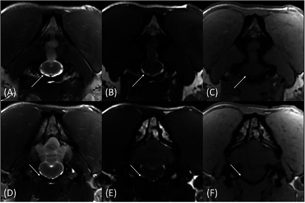 Transverse T2W (A and D), FIESTA‐C (B and E), and LAVA (C and F) magnetic resonance images of the same patient showing the intracranial (A–C) and intraforaminal portions of CN XII through the hypoglossal canal (D–F) (arrows). The very small CN XII is barely visible on the T2W image (A) but more conspicuous on the FIESTA image (B). The hypoglossal canal is better outlined on the LAVA image (arrow, F) and allows for cross‐referencing the nerve on the FIESTA image (arrow, E).