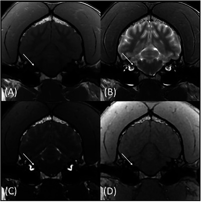 Transverse T1W (A), T2W (B), FIESTA‐C (C), and LAVA (D) magnetic resonance images of the same patient at the level of CN VIII (arrows). The CN VIII is more conspicuously identified on the FIESTA‐C (C) and LAVA (D) images.