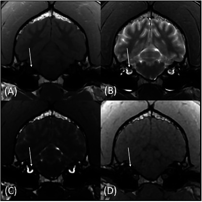 Transverse T1w (A), T2w (B), FIESTA‐C (C), and LAVA (D) magnetic resonance images of the same patient at the level of CN VII (arrows). The CN VII is more conspicuously identified on the FIESTA‐C (C) and LAVA (D) images.