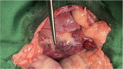 Intraoperative photograph from exploratory laparotomy at initial diagnosis. The retroperitoneal mass shows an irregular surface with multifocal haemorrhagic discoloration. Excision was not possible due to extensive adhesions and haemorrhage risk; a limited biopsy was obtained.