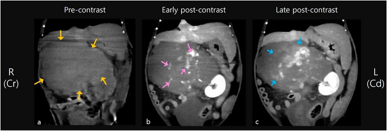 Contrast‐enhanced computed tomography (CT) of the abdomen at initial diagnosis, dorsal plane, soft‐tissue window. (a) Pre‐contrast image showing a large retroperitoneal mass (12.1 × 8.0 × 8.5 cm) of homogeneous soft‐tissue attenuation (yellow arrows). (b) Early post‐contrast image revealing heterogeneous enhancement with focal regions of strong contrast uptake (pink arrows). (c) Late post‐contrast image demonstrating progressive contrast distribution into surrounding parenchyma (blue arrows).
