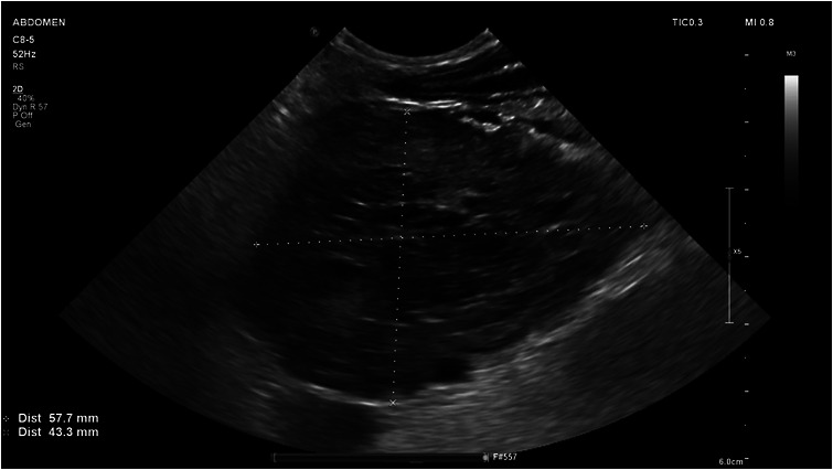 Abdominal ultrasonography at initial diagnosis. (a) Transverse view showing a large heterogeneous hypoechoic mass (5.8 × 4.3 cm) with poorly defined margins. (b) Longitudinal view adjacent to the right kidney demonstrating the same heterogeneous mass, with a small amount of peritoneal effusion.