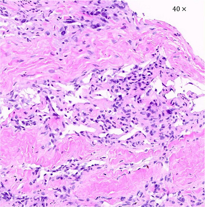 Histopathologic image of the retroperitoneal mass. Haematoxylin and eosin stain, original magnification ×40 (0.216 mm2). The biopsy sample consists of polygonal to polyhedral cells embedded in a fibrocollagenous stroma. The image shows a superficial biopsy specimen that is nondiagnostic due to severe cautery artefact; this image is not intended to demonstrate definitive histologic features of HSA but to illustrate the limitations of the available tissue.