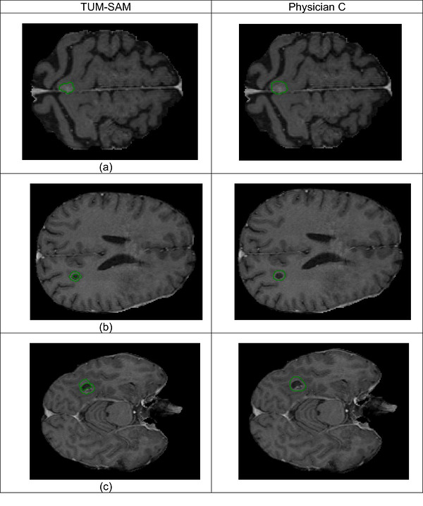 Illustrative examples from the rater study. Figure5(a): top row shows a case in which both raters (Physician A and Physician B) preferred the TUM‐SAM generated contour over that of Physician C. Figure5(b) and (c): the second and third rows show cases in which all raters judged the TUM‐SAM contour to be inferior to Physician C's contour when TUM‐SAM only contour only the hyperintense enhancing rim.