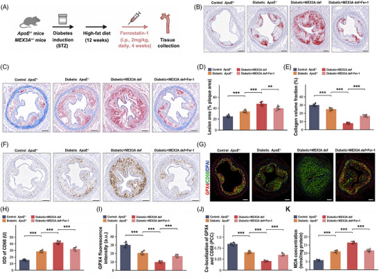 Ferrostatin‐1 (Fer‐1) partially attenuates plaque destabilisation associated with Mex‐3 RNA‐binding family member A (MEX3A) deficiency in vivo. (A) Schematic of the in vivo Fer‐1 treatment design. DiabeticApoE−/−Mex3a+/−mice were treated with Fer‐1 (2 mg/kg, intraperitoneal injection, daily) for the final 4 weeks of high‐fat diet (HFD) feeding. (B and D) Oil Red O staining of aortic root sections and lesion area quantification. Scale bars, 200 µm. (C and E) Masson's trichrome staining and collagen volume fraction quantification. Scale bars, 200 µm. (F and H) CD68 immunohistochemistry and quantification. Scale bars, 200 µm. (G, I, and J) Immunofluorescence images showing GPX4 (red), CD68 (green) and 4′,6‐diamidino‐2‐phenylindole (DAPI) (blue), with quantification of GPX4 fluorescence intensity and GPX4/CD68 co‐localisation by Pearson correlation coefficient (PCC). Scale bars, 200 µm. (K) Aortic malondialdehyde (MDA) concentration.n= 6 mice per group. Data are mean ± standard deviation (SD). One‐way analysis of variance (ANOVA) with Tukey's post hoc test.**p< .01;***p< .001.