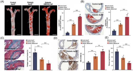 Mex‐3 RNA‐binding family member A (MEX3A) deficiency exacerbates plaque burden and promotes morphological features of plaque instability in diabetic atherosclerosis. (A) En face Oil Red O staining of whole aortas and quantification of lesion area as percentage of total aortic surface. Scale bars, 5 mm. (B) Oil Red O staining of aortic root cross‐sections and quantification of lesion area as percentage of plaque area. Scale bars, 100 µm. (C) Masson's trichrome staining and quantification of collagen volume fraction. Scale bars, 200 µm. (D) CD68 immunohistochemistry and quantification of CD68 immunoreactive signal. Scale bars, 100 µm. (E) Quantification of fibrous cap thickness.n= 6 mice per group. Data are mean ± standard deviation (SD). One‐way analysis of variance (ANOVA) with Tukey's post hoc test.**p< .01;***p< .001.
