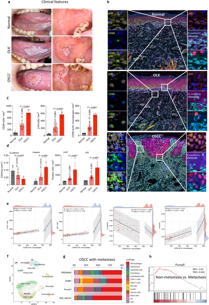 Senescent macrophages are closely related to human oral squamous cell carcinoma progression. (a) Clinical images are representative of human normal oral mucosa, oral leukoplakia (OLK) and oral squamous cell carcinoma (OSCC) in the tongue and buccal areas. (b) Representative 7‐color multiplex immunofluorescence (mIF) images showing the co‐expression of CD68, p16, p53, Ki‐67, E‐cadherin and Vimentin proteins in human oral normal mucosa, OLK, and OSCC patients. Scale bars, 100 μm. (c) Quantification of CD68, p16, and CD68/p16 in different human oral samples from each patient (CD68/p16 positive cells:N= 10 in normal,n= 43 in OLK,n= 11 in OSCC; CD68 and p16 positive cells:N= 9 in normal,n= 43 in OLK,n= 11 in OSCC). (d) Quantification of Ki‐67, p53, E‐cadherin and Vimentin in different human oral samples from each patient (Ki‐67/p53/E‐cadherin/Vimentin positive cells:N= 10/10/9/9 in normal,n= 42/42/30/30 in OLK,n= 9/9/9/8 in OSCC). (e) Pearson correlation analysis was performed to analyze the relationships between CD68+/p16+ senescent macrophages and Ki‐67+, p53+, Vimentin+, and E‐cadherin+ cells. (f) Uniform manifold approximation and projection (UMAP) of single‐cell RNA sequencing (scRNA‐seq) of all cells from metastasis OSCC, identifying 13 clusters. (g) Gene Set Enrichment Analysis (GSEA) results showing that these cells in scRNA‐seq data were annotated using gene module scores for senescent cells in the FRIDMAN Senescence, GOBP Cellular Senescence, Purcell and Sen MAYO datasets. (h) GSEA enrichment plot of bulk RNA sequencing of senescence‐associated genes between non‐metastasis OSCC and OSCC with metastasis in Purcell sets. Statistical significance was determined by permutation analysis. The percentage of positive cells was determined by one‐way ANOVA with Tukey's post hoc test (c, d).