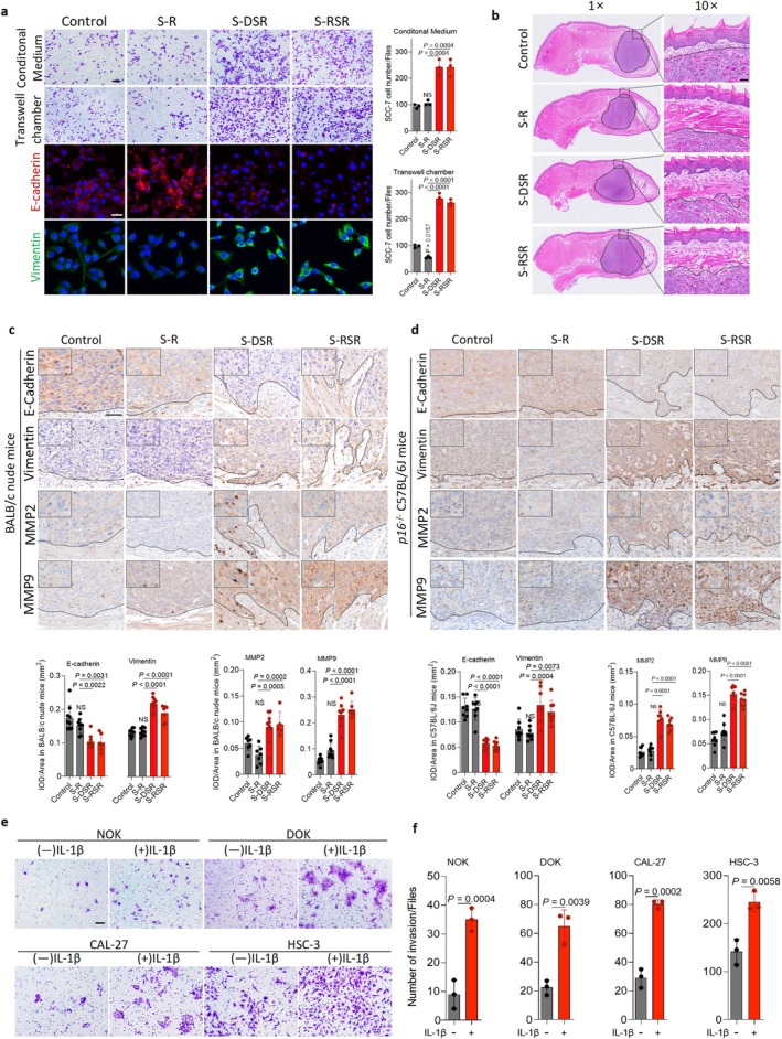 Senescent macrophages secrete IL‐1β for promoting oral cancer invasion. (a) Top: Representative images and quantification of invasion in transwell assays using conditioned medium (CM) or co‐culture with R, DSR or RSR. SCC‐7 cells were treated with CM derived from R, DSR or RSR. Bottom: Representative immunofluorescence images of E‐cadherin and Vimentin in SCC‐7 cells co‐cultured in transwell chamber under different conditions (alone, R, DSR, RSR, J, DSJ or RSJ). Scale bar, 100 μm (top) and 50 μm (bottom). (b) H&E staining images of tongue orthotopic OSCC xenograft model. Scale bar, 50 μm. (c‐d) Representative IHC images and quantification analysis of E‐cadherin, Vimentin, MMP2 and MMP9 staining in tumor sections from BALB/c nude mice andp16−/−C57BL/6J mice implanted with SCC‐7 cells with or without macrophages. BALB/c nude mice model: SCC‐7 cells alone (n= 9), SCC‐7 cells and RAW264.7 cells (S‐R) (n= 9), SCC‐7 cells and DSR (S‐DSR) (n= 10), SCC‐7 cells and RSR (S‐RSR) (n= 7).p16−/−C57BL/6J mice model: SCC‐7 cells (n= 8), S‐R (n= 8), S‐DSR (n= 8), and S‐RSR (n= 8). Scale bar, 50 μm. (e‐f) Representative images and quantification of invasion assays. Human derived cell lines including normal oral keratinocytes (NOK), dysplastic oral keratinocytes (DOK), tongue squamous cell carcinoma cells (CAL‐27) and OSCC cells (HSC‐3) were treated with exogenous IL‐1β. Scale bar, 100 μm.n= 3 in each group from independent biological replicates (a, e). Statistical significance was determined by one‐way ANOVA with Tukey's post hoc test; mean ± s.d. (a, c, d, f).