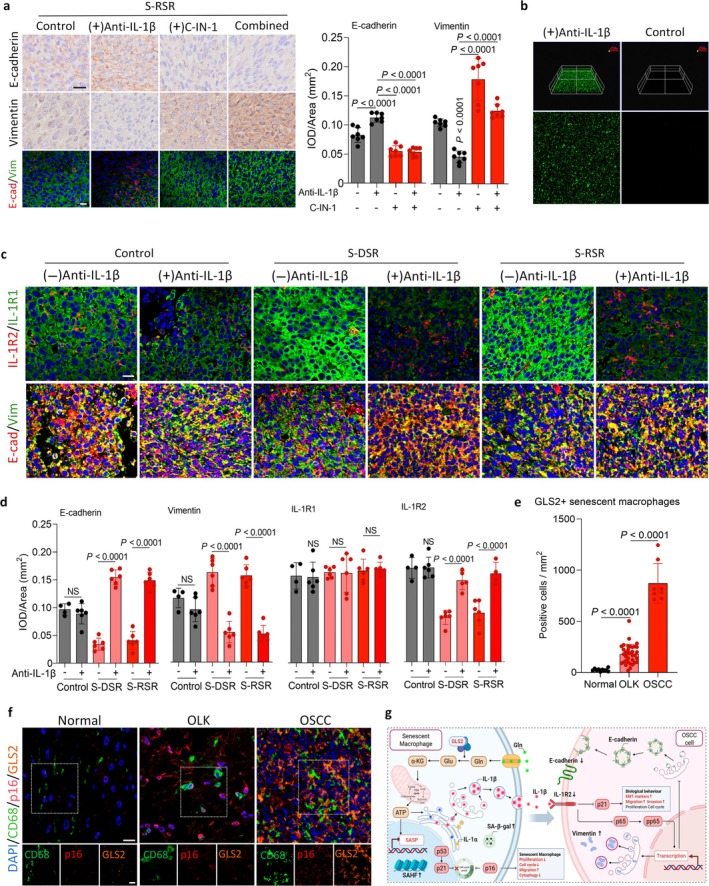 Inhibition of IL‐1β reduces Vimentin and increases E‐cadherin to suppress OSCC invasion in vivo. (a) Representative IHC and mIHC images, and quantification of E‐cadherin and Vimentin in tumor sections from S‐RSR treated with anti‐IL‐1β antibody, C‐IN‐1, or a combination of the anti‐IL‐1β antibody and C‐IN‐1 (n= 7 independent biological replicates for each group). Scale bars, 20 μm (upper), 20 μm (bottom). (b) Representative images showing anti‐IL‐1β antibody in 15% w/v PLGA‐PEG‐PLGA gel. (c, d) Representative mIHC images (c) and quantification (d) of E‐cadherin, Vimentin, IL‐1R1 and IL‐1R2, in nude mice bearing tumor derived from SCC‐7 cells alone, S‐DSR or S‐RSR treated with or without the anti‐IL‐1β antibody (n= 6 in the comparisons exceptn= 4 in the group of SCC‐7 cells alone + vehicle). Scale bars, 20 μm. (e, f) Representative mIHC images (f) and quantification (e) of CD68, p16, and GLS2 in normal human oral mucosa, OLK and OSCC tissues (n= 10 in normal,n= 38 in OLK,n= 8 in OSCC). Scale bars, 20 μm (upper), 10 μm (bottom). (g) Schematic illustrating GLS2+ senescent macrophages with activated glutamine metabolism promote Vimentin expression and suppress E‐cadherin during OSCC invasion. The glutamine metabolism/IL‐1β/IL‐1R/NFκB pathway is critical for this process, but it can be inhibited by blocking IL‐1β. Statistical significance was determined by one‐way ANOVA with Tukey's post hoc test; mean ± s.d. (a, d, e).
