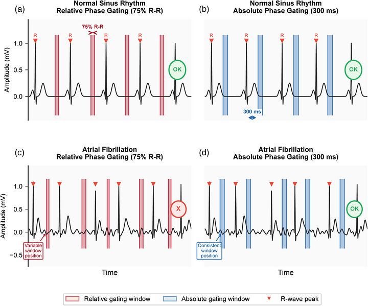 Schematic Illustration of ECG Gating Strategies in Normal Sinus Rhythm and Atrial Fibrillation. (a) Relative phase gating (75% R‐R interval) in normal sinus rhythm: acquisition windows (red shading) are consistently positioned at the diastolic phase due to regular R‐R intervals. (b) Absolute phase gating (300 ms post‐R‐wave) in normal sinus rhythm: acquisition windows (blue shading) target the mid‐systolic quiescent period at a fixed delay after each R‐wave. (c) Relative phase gating in atrial fibrillation: highly irregular R‐R intervals cause variable window positions, potentially capturing different cardiac phases in each beat, leading to inconsistent image quality (marked X). (d) Absolute phase gating in atrial fibrillation: despite R‐R interval variability, the fixed 300 ms delay consistently targets the same systolic quiescent phase in each beat (marked OK), providing reliable image quality. Red triangles indicate R‐wave peaks. Note the absence of P waves and presence of fibrillatory baseline in panels C and D, characteristic of atrial fibrillation.