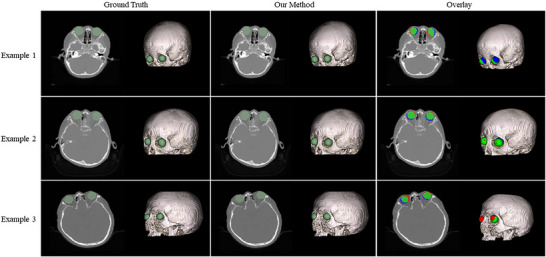 Sample results of 3D eyeball model generation. For each example, the ground truth mask (left), the predicted mask from our method (middle), and the color‐coded overlay (right) are shown. Each mask is displayed in axial view and volume rendering. In the overlay: green indicates voxels where the prediction and ground truth agree (true positive); red indicates voxels predicted as eyeball but not present in the ground truth (false positive); blue indicates voxels present in the ground truth but missed by the prediction (false negative).