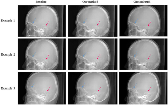 Qualitative comparison of synthetic topograms. Representative examples showing the baseline cTopogram (Baseline), the proposed uTopogram (Our Method), and the real topogram (Ground Truth). Blue arrows indicate blurred orbital rim margins in the cTopogram; red arrows indicate morphological distortion of auricular structures in the cTopogram.