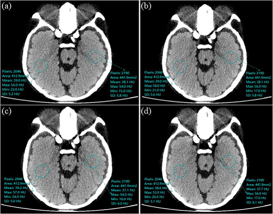 Exemplary phantom images and noise measurement ROIs (blue circles). (a) Axial scan without eye protection. (b) Axial scan with eye protection. (c) Helical scan without eye protection. (d) Helical scan with eye protection. For each ROI, the annotated values report the number of pixels, area, mean CT number, maximum, minimum, and standard deviation (SD). The SD directly corresponds to the noise used in the quantitative analysis (Table3).