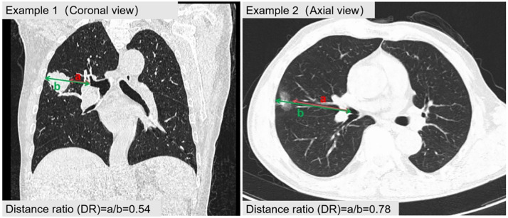 Illustration of DR measurement.Two distances are defined: (a) from the hilum to the proximal margin of the tumor; and (b) from the hilum, through the center of the tumor, to the visceral pleura. The DR is calculated as the ratio of (a) to (b).