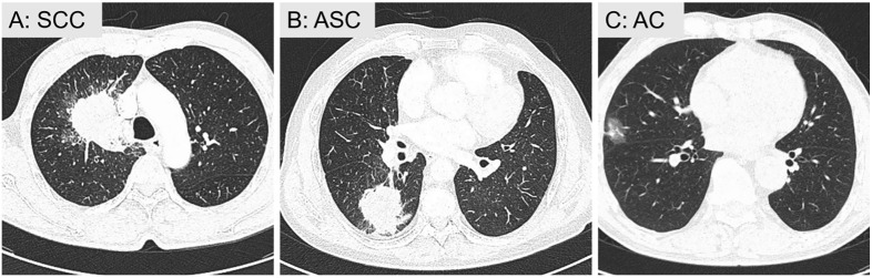 Representative CT images of three patients with different histological subtypes.A.A 68-year-old male with a DR of 0.00. Pathologically confirmed SCC without LNM.B.A 73-year-old male with a DR of 0.45. Pathologically confirmed ASC with LNM.C.A 60-year-old male with a DR of 0.76. Pathologically confirmed AC without LNM.
