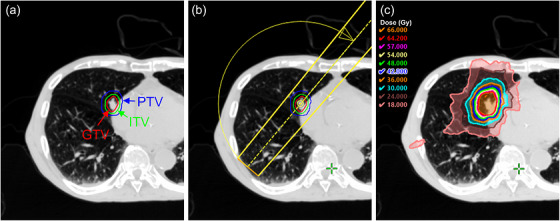 Overview of a representative clinical case (Patient Case 1) used for the dosimetric impact assessment. (a) Axial CT image showing the delineation of the GTV, ITV, and PTV. (b) Beam arrangement for the VMAT plan utilizing a partial arc. (c) Resulting dose distribution.