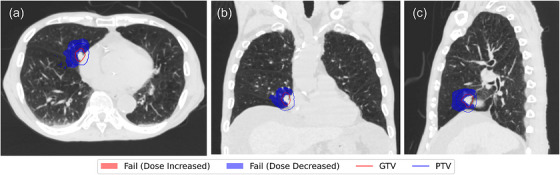 3D gamma analysis results for the worst‐case scenario (Case 1) evaluated with the 2%/1 mm criteria. Axial, coronal, and sagittal views are shown. Failing voxels (indicated in blue) represent regions where the dose recalculated with the RT was lower than the initial calculation.
