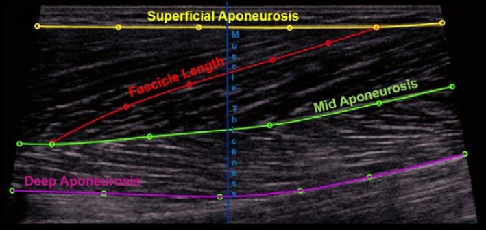 A schematic ultrasound image of bicep femoris long head muscle.